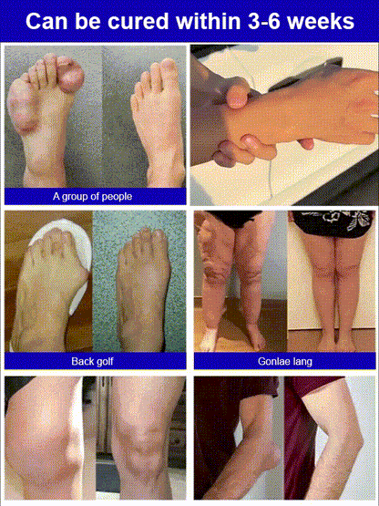 Uric Acid Excretion Joint Patch